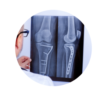 Рентген голени Рентген голени