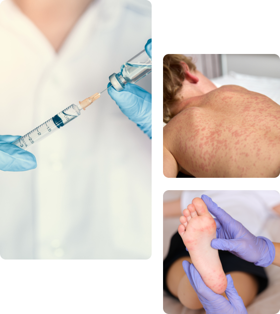 Осложнения после прививки от краснухи детям