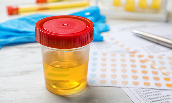 Общий анализ мочи Общий анализ мочи