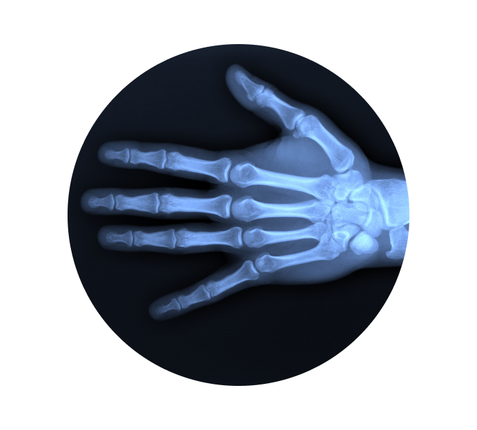 Рентген пальцев Рентген пальцев