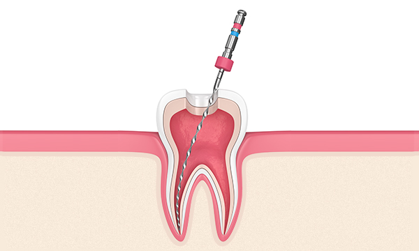 Обработка корневого канала Обработка корневого канала