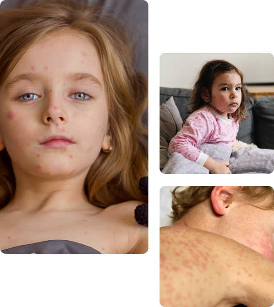 Осложнения после вакцинации детей от кори Осложнения после вакцинации детей от кори