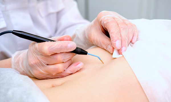 Электрокоагуляция Электрокоагуляция