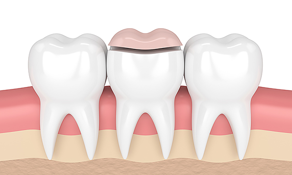Временное пломбирование корневого канала Временное пломбирование корневого канала