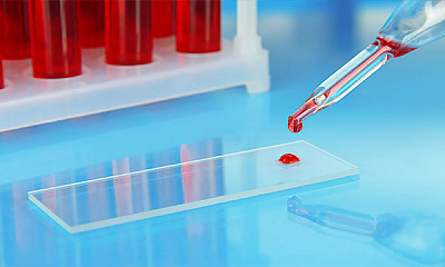 Анализ крови на трансферрин