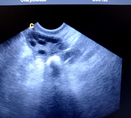 УЗИ маточных труб УЗИ маточных труб