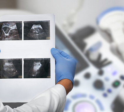 УЗИ селезенки УЗИ селезенки